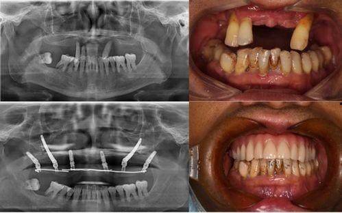 佛山种牙爆料事件视频最新,揭露行业乱象，患者权益谁来守护？  第3张